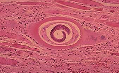 Личинка трихинеллы в мышечной ткани